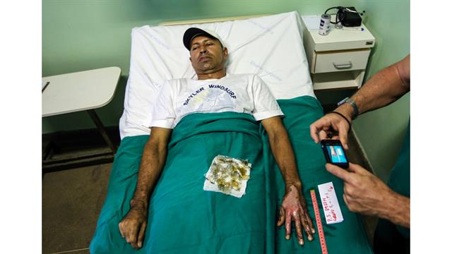 Una enfermera toma una fotografía de la piel quemada de un paciente que está siendo sometido a un tratamiento con piel tilapia en el Instituto Dr. José Frota en Fortaleza, Brasil